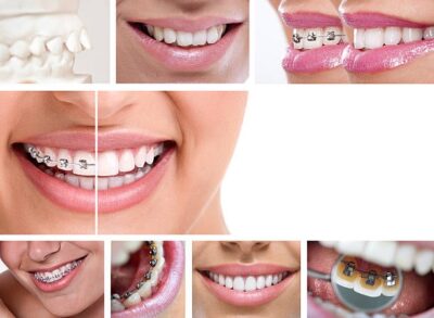 Why Clear Braces Are a Popular Choice for CosmeticOrthodontics in Kelowna