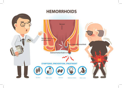 Guide to Pain-Free Hemorrhoid Treatment