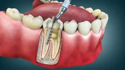 Root Canal from a Falls Church Dentist